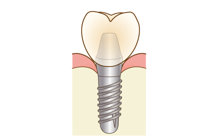 インプラント