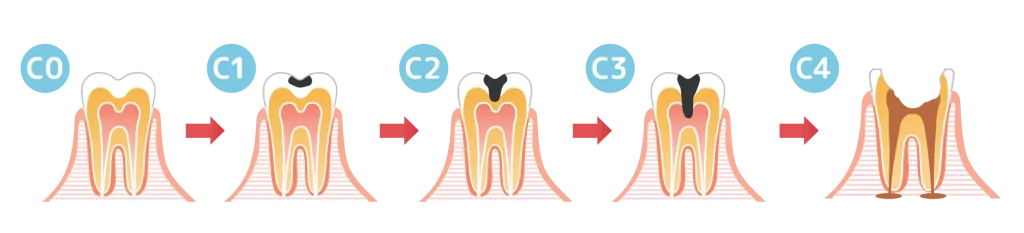 虫歯の進行