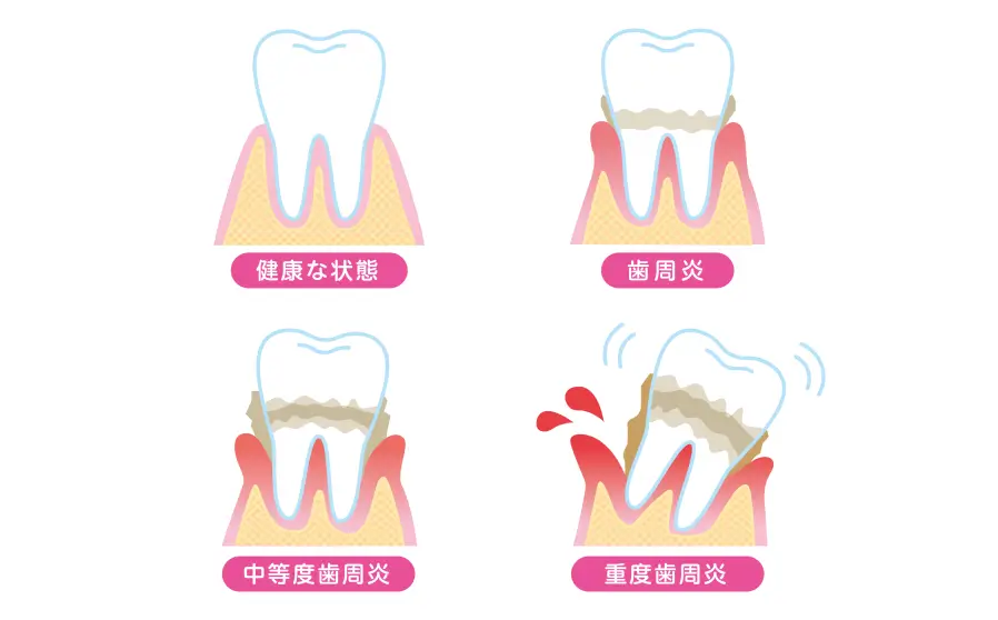 歯周病の主な治療法