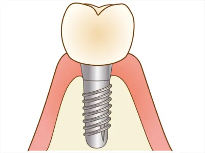 implant 13
