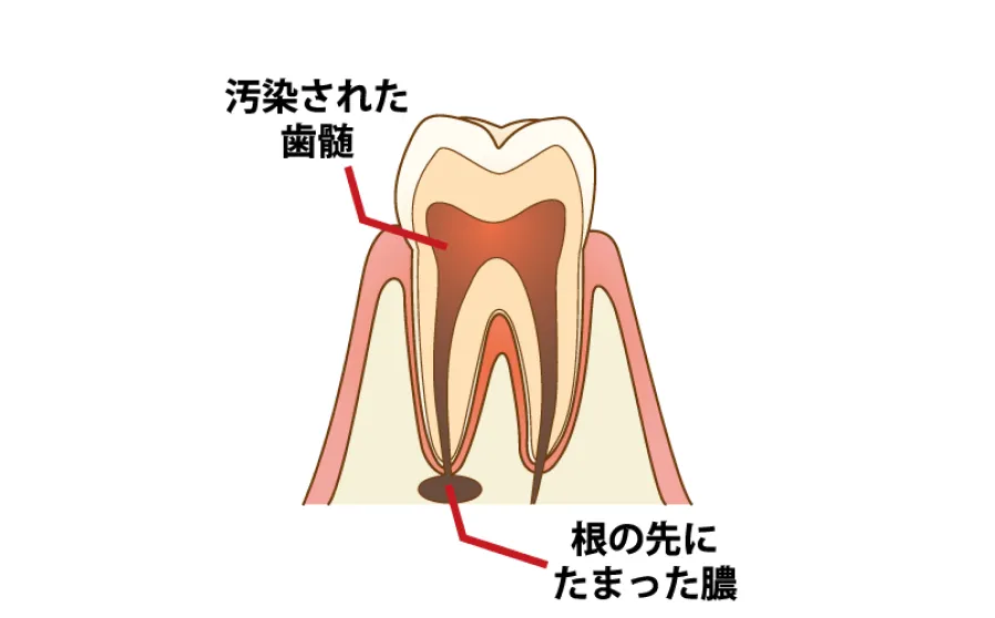 根管治療の主な治療法