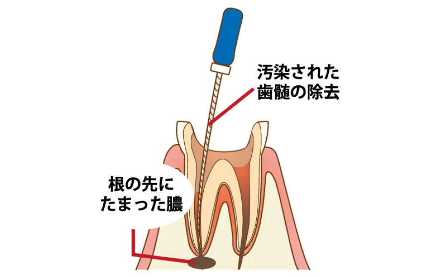 根管治療の主な治療法