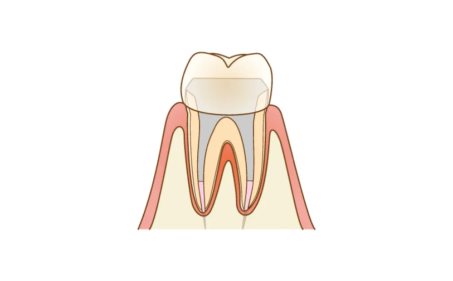 根管治療の主な治療法